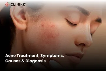 Acne Treatment, Symptoms, Causes & Diagnosis