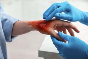 Wound Infection