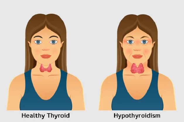 Hypothyroidism treatment