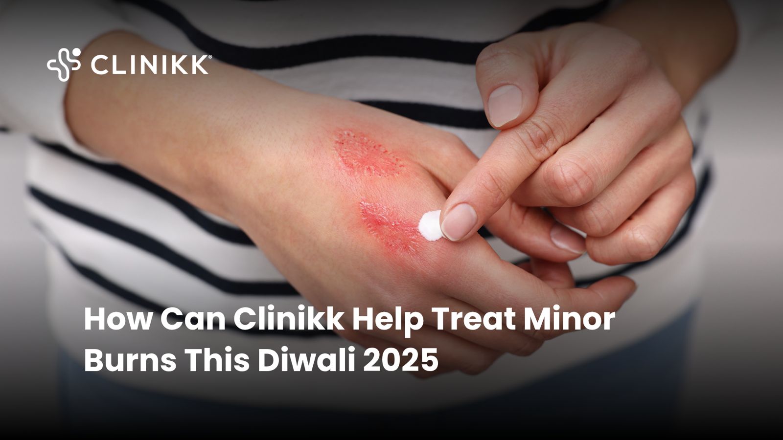 How Clinikk Health Hub Can Help You Treat Firecracker Burns This Diwali 2025